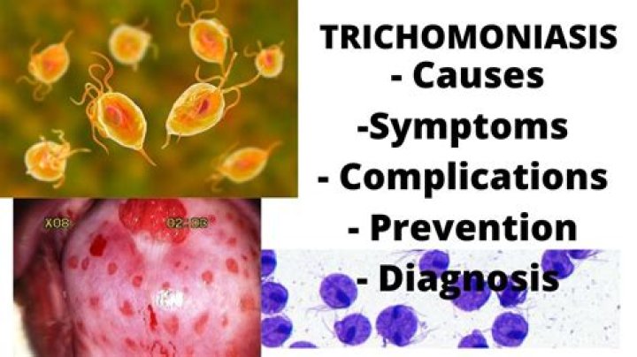 Can BV cause trichomoniasis