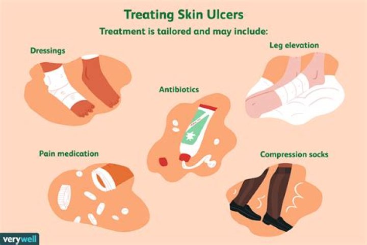 How do you treat decubitus ulcers
