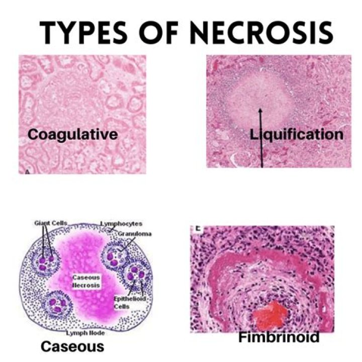How many types does necrosis have