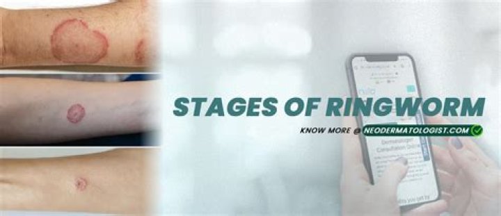 How quickly does ringworm show up