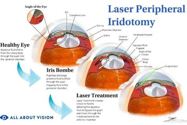 How successful is laser iridotomy