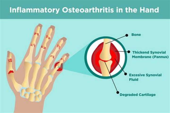 Is erosive osteoarthritis serious