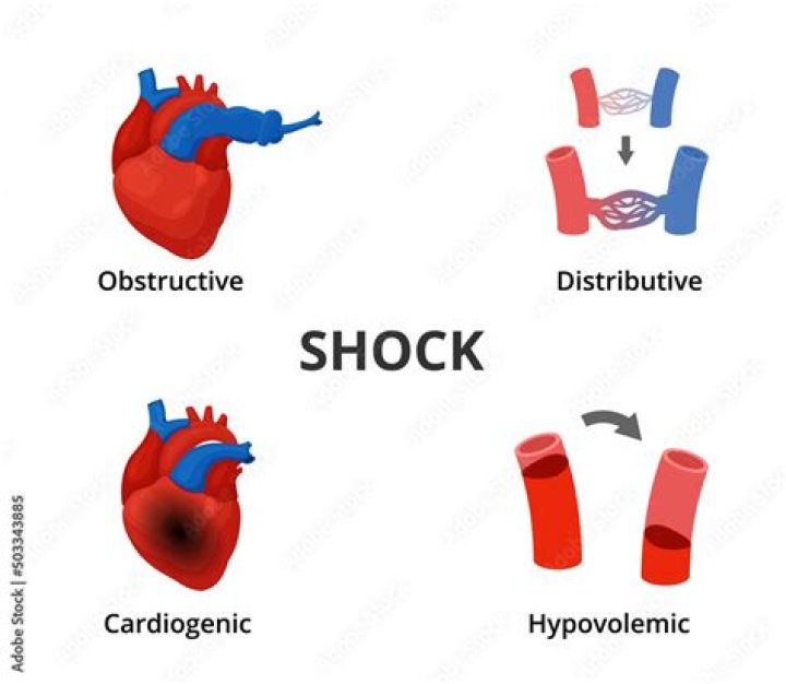 What are the 4 types of pneumonia