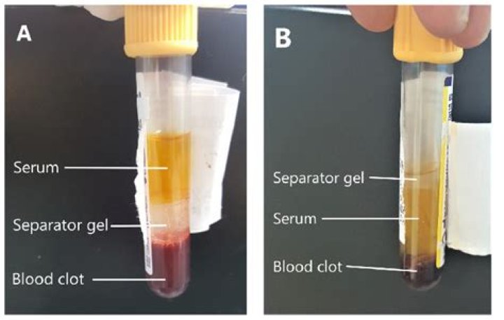 What does a serum blood test show
