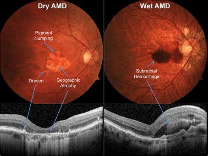 What is macular degeneration in the eye